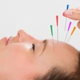 Migren tedavisinde akupunkturun yeri