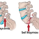 SPONDİLOLİSTEZİS (BEL KAYMASI)
