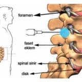 LAZER İLE KİREÇLENME (FASET ARTROZU/ SPONDİLOZ) TEDAVİSİ