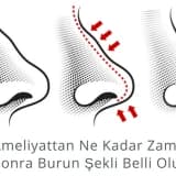 Ameliyattan Ne Kadar Zaman Sonra Burun Şekli Belli Olur?