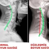 Boyun Düzleşmesi Hastalığı