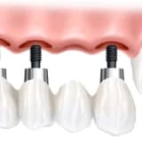 kısaca dental implant