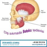 Diş Sıkma (Masseter) botoksu nedir?