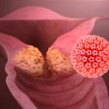 HPV( Human Papilloma Virüs) Enfeksiyonu ve Korunma