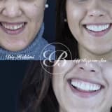 Gülüş tasarımı (smile design,gülüş estetiği) nedir?