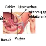 AŞILAMA (IUI - Intra Uterin Inseminasyon)