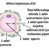 Tüp Bebek (IVF: In Vitro Fertilizasyon)
