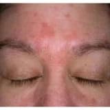 Sık görülen bir deri hastalığı: Seboreik Dermatit!