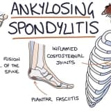 ANKİLOZAN SPONDİLİT HAKKINDA BİLİNMESİ GEREKENLER