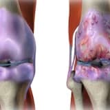 OSTEOARTRİT (EKLEM KİREÇLENMESİ)