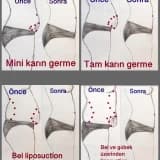 Karın Germe Operasyonu Hakkında Sık Sorulan Sorular