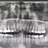 20 yaş dişleri her zaman çekilmeli midir?