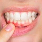 Diş Eti Kanamaları ve Oral Hijyenin Hayatımızdaki Önemi