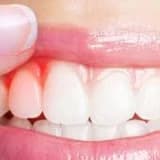 Diş Eti Kanaması Neden Olur, Nasıl Geçer?