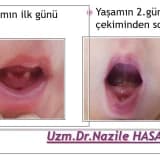 Yenidoğan Bebekte Diş