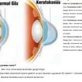 SORU VE CEVAPLARLA A’DAN Z’YE KERATOKONUS VE HİBRİD TEDAVİ