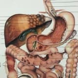 ERCP, safra kesesi ameliyatının alternatifi değildir"