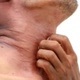 Atopik dermatit (atopik ekzema)