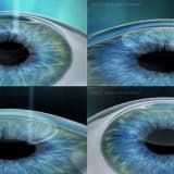 Relex smile, 3. Kuşak laser cerrahisi