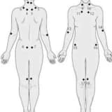 Fibromiyalji: Nedir? Tedavi de Kullanılan Yöntemler Nelerdir?