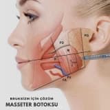 Masseter kasına Botoks