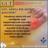 Gut (Damla Hastalığı)