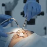 Pterjium (Göz Eti) Ameliyatı