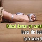 Kılcal damar ve varislerin lazer ile tedavisi