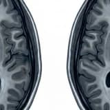 Beyin MR’ında “Sıvı Artışı” Görüldü: Ne Zaman Ciddi Bir Sorun?