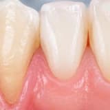 Diş Eti Çekilmesi Nedir? Neden Oluşur ve Nasıl Tedavi Edilir?