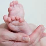 Yenidoğanlarda Ayak Ve Tırnak Problemleri