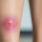 TENDON AĞRILARIM NEDEN TAM OLARAK İYiLEŞMiYOR?