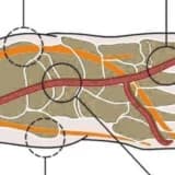 Tarsal Tünel Sendromu (TTS; Ayak Bileği Sinir Zedelenmesi Hastalığı)