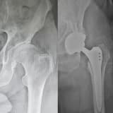 KALÇA KİREÇLENMESİ VE TOTAL KALÇA PROTEZİ