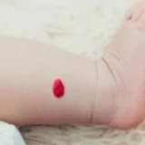 Hemanjiom Çeşitleri Nelerdir