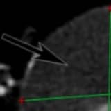 Aort Anevrizması Nedir?