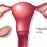 PKOS NEDİR VE NASIL BESLENİLMELİDİR?
