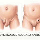 Çocuklarda Kasık Fıtığı (İnguinal Herni): Kasıkta Şişlik Varsa Ne Yapılmalı?