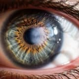 Katarakt Nedir? Belirtileri ve Tedavi Yöntemleri