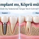 İmplant mı Köprü mü? Eksik Diş Tedavisinde Hangisi Daha İyi? Avantajları ve Farkları