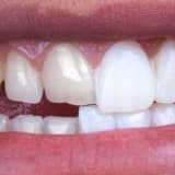 LAMİNA (YAPRAK DİŞ)