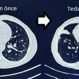 AKCİĞER KANSERİNDE HEDEFE YÖNELİK (AKILLI İLAÇ) TEDAVİ