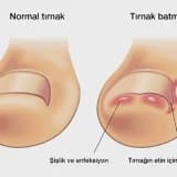 Ankara’da Batık Tırnak Tedavisi