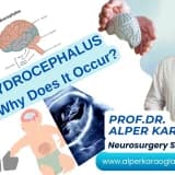 What is HYDROCEPHALUS Disease? Why Does It Occur?