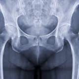Kalça Eklemi Osteoartrit ( Kireçlenme)