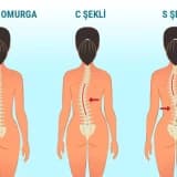 Skolyoz Tedavisinde Schroth Terapi