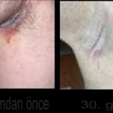 Hidradenitis Suppurativa - Köpek Memesi Hastalığı