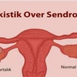 POLİKİSTİK OVER SENDROMU