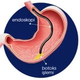 MİDE BOTOKSU İLE İDEAL KİLONUZA KAVUŞUN!