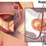 Prostat Hastalığı